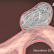 Illustration for article titled What Is Coil Embolization?